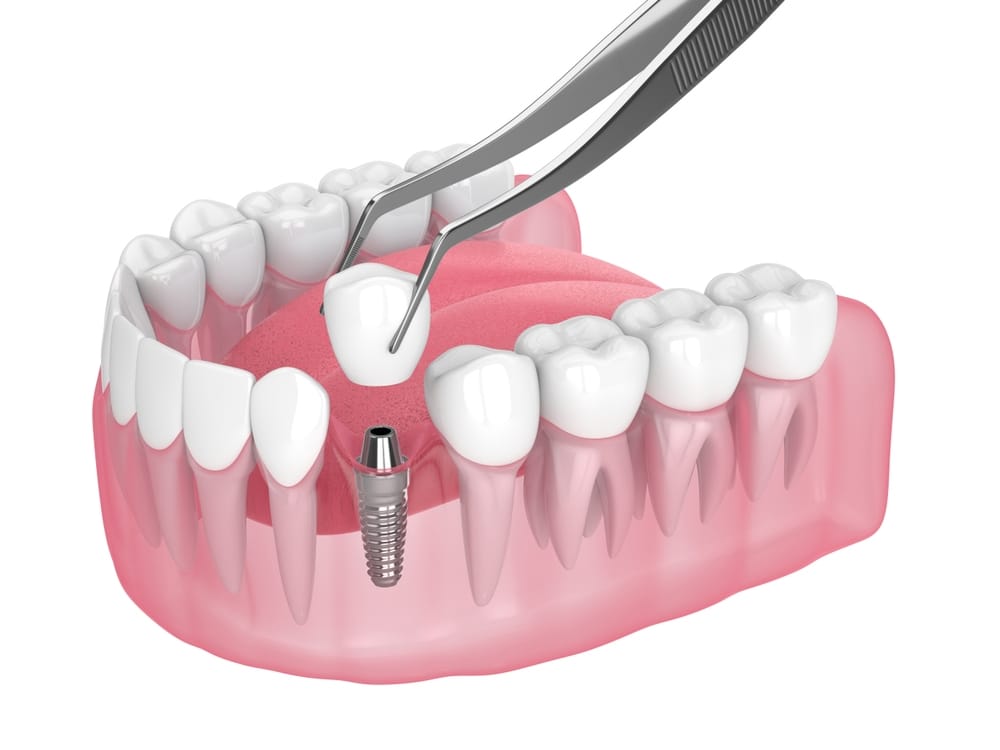 Dental Implants