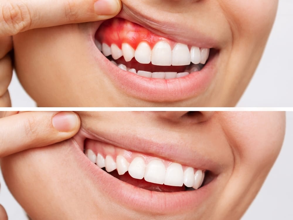 Gum Disease Treatment