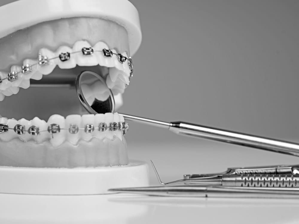 Orthodontic Braces